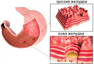 Портальная гипертензия при циррозе печени