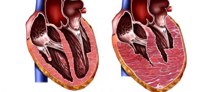 Гипертрофия левого желудочка сердца: лечение, причины, признаки