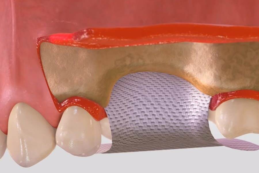 primenenie-membrany-dlya-kostnoj-plastiki-pri-implantatsii